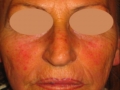 laser-vascolari2-medicina-agolli