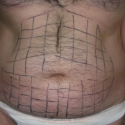 Liposuzione-addome