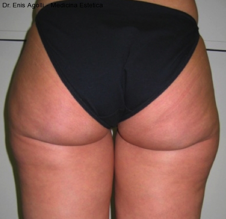 Mesoterapia-cellulite-adiposita-localizzata-agolli