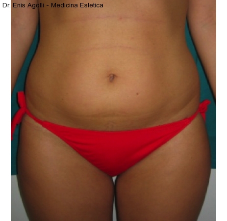 Mesoterapia2-cellulite-adiposita-localizzata-agolli