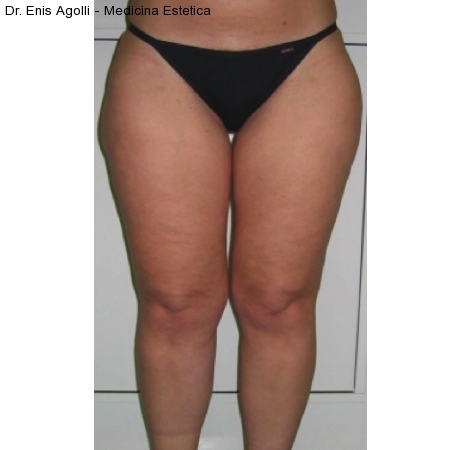 Mesoterapia3-cellulite-adiposita-localizzata-agolli