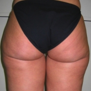 Mesoterapia-cellulite-adiposita-localizzata-agolli