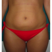 Mesoterapia2-cellulite-adiposita-localizzata-agolli