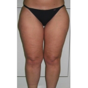 Mesoterapia3-cellulite-adiposita-localizzata-agolli