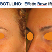 6botulino-brow lift